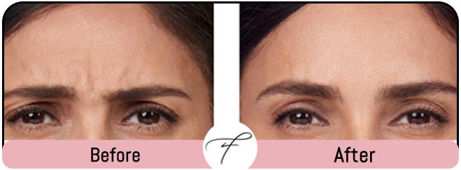 Frown Lines Correction by Flawless Medspa