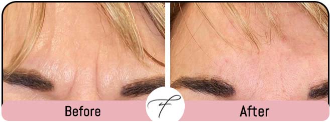 Frown Lines Correction by Flawless Medspa