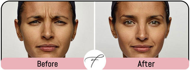 Two Weeks Prior to Your Injectable Appointment Two Weeks Prior to Your Injectable Appointment