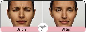Two Weeks Prior to Your Injectable Appointment Two Weeks Prior to Your Injectable Appointment