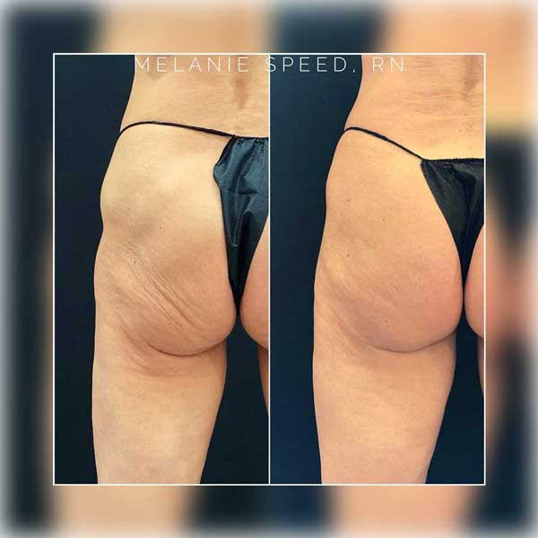 Butt Lift Before & After Photos by Flawless Medspa in Las Vegas, NV