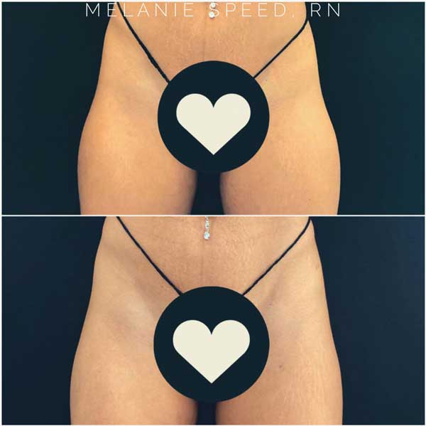 Butt Lift Before & After Photos by Flawless Medspa in Las Vegas, NV