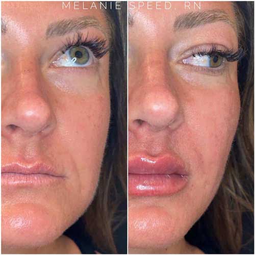 Cheek Fillers Before and After Photos by Flawless Medspa in Las Vegas NV