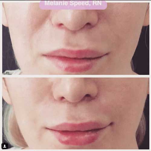 Cheek Fillers Before and After Photos by Flawless Medspa in Las Vegas NV