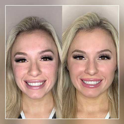 Cheek Fillers Before and After Photos by Flawless MedSpa & The Beverly Hills MedSpa in Beverly Hills, CA and Las Vegas, NV Cheek Fillers Before and After Photos by Flawless MedSpa & The Beverly Hills MedSpa in Beverly Hills, CA and Las Vegas, NV