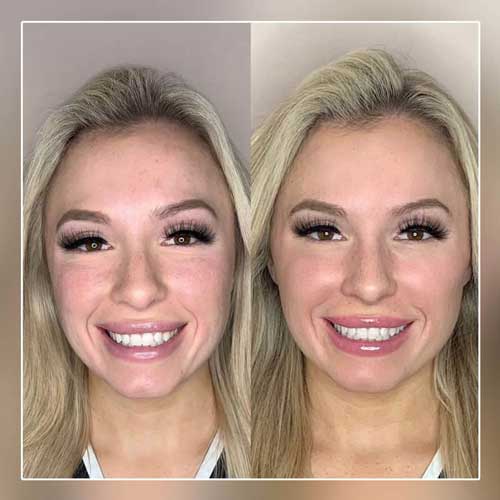 Cheek Fillers Before and After Photos by Flawless Medspa in Las Vegas NV