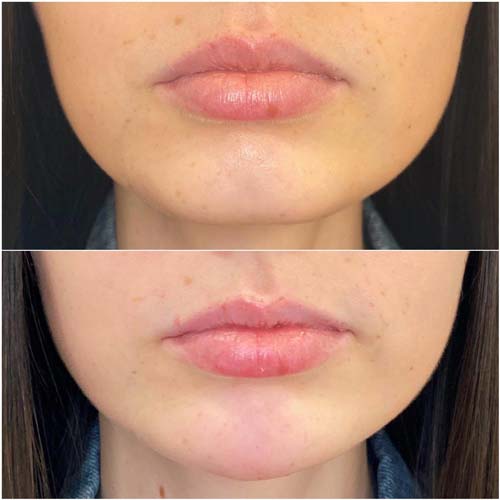 Chin & Jawline Correction by Flawless Medspa