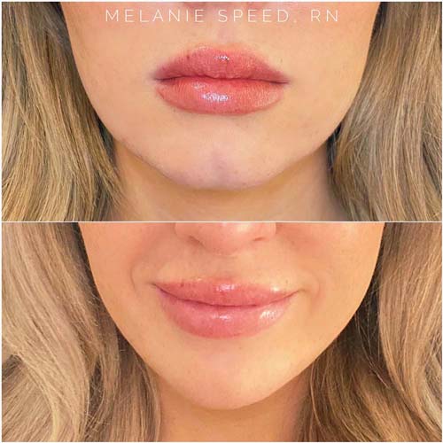 Chin & Jawline Correction by Flawless Medspa