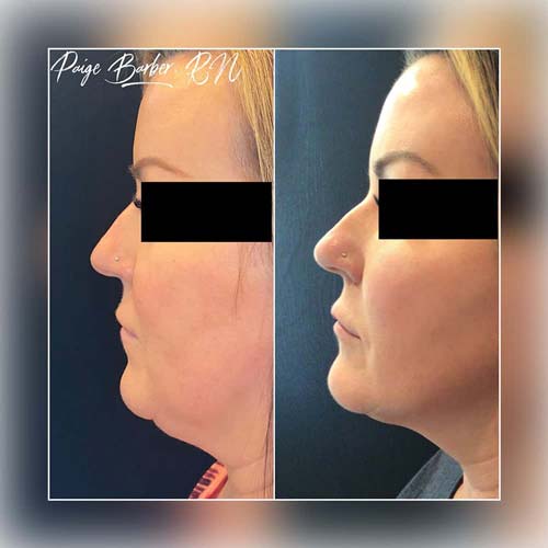 Chin & Jawline Correction by Flawless Medspa