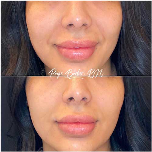 Cheek Fillers Before and After Photos by Flawless Medspa in Las Vegas NV