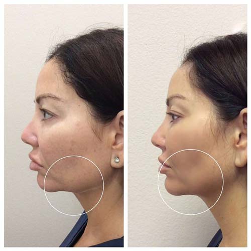 Chin & Jawline Correction by Flawless Medspa