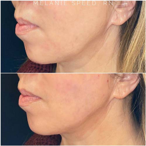 Chin & Jawline Correction by Flawless Medspa