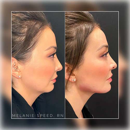 Chin & Jawline Correction by Flawless Medspa