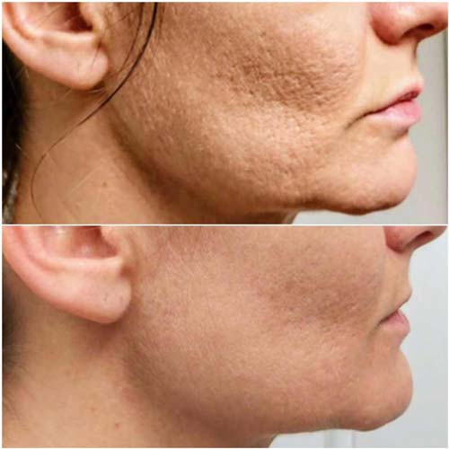 Chin & Jawline Correction by Flawless Medspa