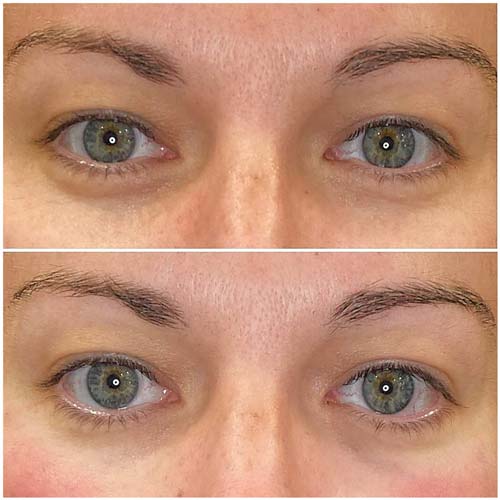 Plasma IQ Skin Treatment for Eyes Wrinkles by Flawless Medspa