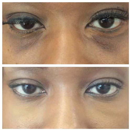 Plasma IQ Skin Treatment for Eyes Wrinkles by Flawless Medspa