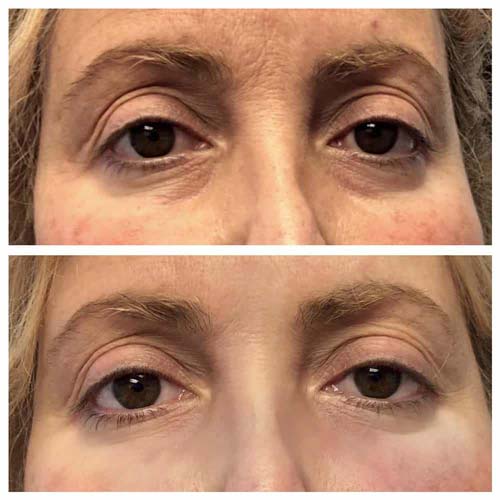 Plasma IQ Skin Treatment for Eyes Wrinkles by Flawless Medspa