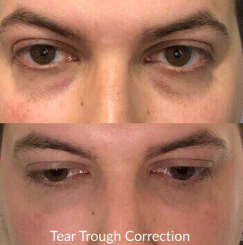 Plasma IQ Skin Treatment for Eyes Wrinkles by Flawless Medspa