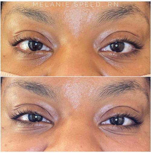 Plasma IQ Skin Treatment for Eyes Wrinkles by Flawless Medspa