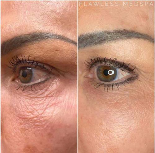 Plasma IQ Skin Treatment for Eyes Wrinkles by Flawless Medspa