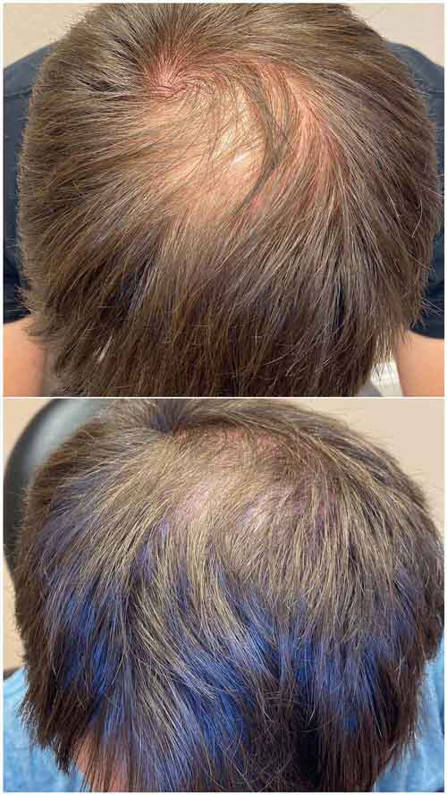 PRP Hair Restoration by Flawless Medspa