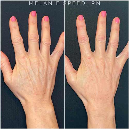 Hand Rejuvenation with Radiesse by Flawless Medspa