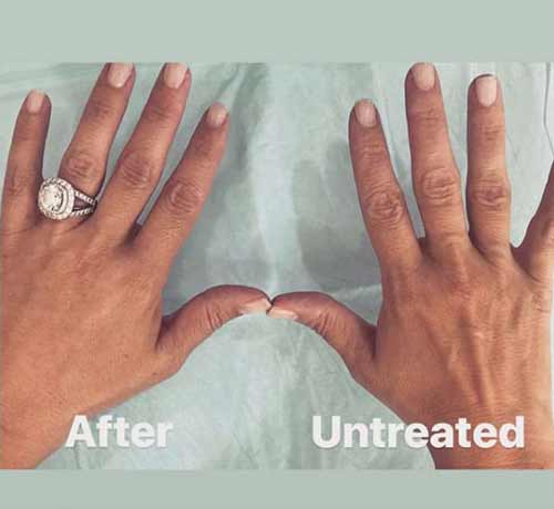 Hand Rejuvenation with Radiesse by Flawless Medspa