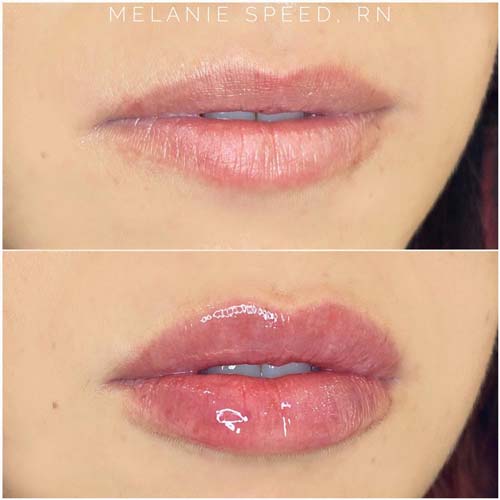 Lip Augmentation Before & After Photos by Flawless Medspa in Las Vegas NV