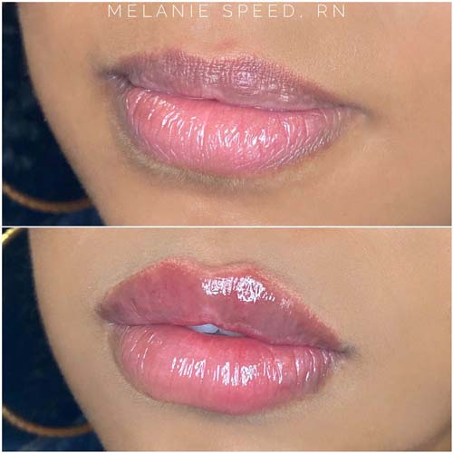 Lip Augmentation Before & After Photos by Flawless Medspa in Las Vegas NV