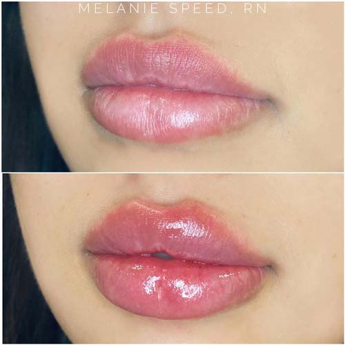 Lip Augmentation Before & After Photos by Flawless Medspa in Las Vegas NV