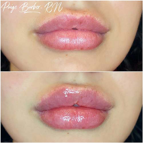 Lip Augmentation Before & After Photos by Flawless Medspa in Las Vegas NV