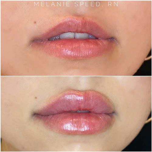 Lip Augmentation Before & After Photos by Flawless Medspa in Las Vegas NV