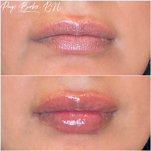 Lip Augmentation Before & After Photos by Flawless Medspa in Las Vegas NV