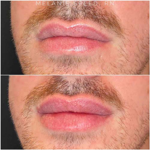 Lip Augmentation Before & After Photos by Flawless Medspa in Las Vegas NV