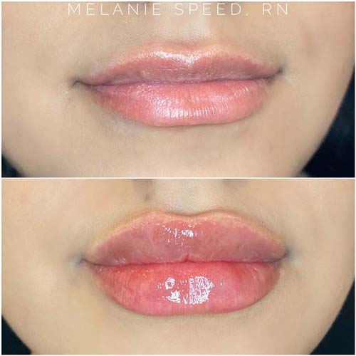 Lip Augmentation Before & After Photos by Flawless Medspa in Las Vegas NV