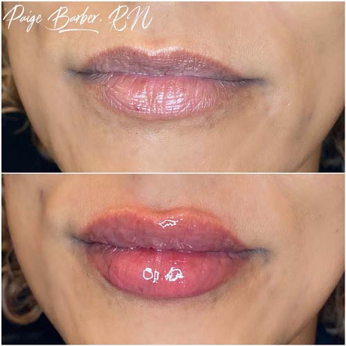 Lip Augmentation Before & After Photos by Flawless Medspa in Las Vegas NV