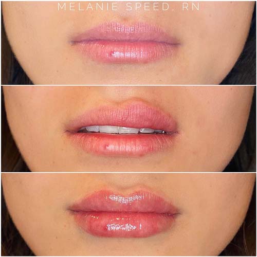 Lip Augmentation Before & After Photos by Flawless Medspa in Las Vegas NV