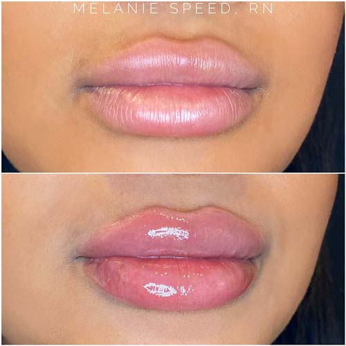 Lip Augmentation Before & After Photos by Flawless Medspa in Las Vegas NV