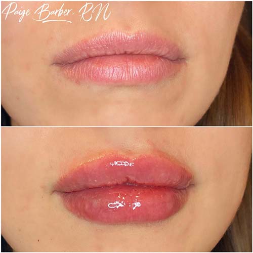 Lip Augmentation Before & After Photos by Flawless Medspa in Las Vegas NV