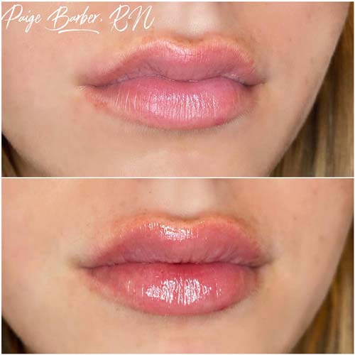 Lip Augmentation Before & After Photos by Flawless Medspa in Las Vegas NV