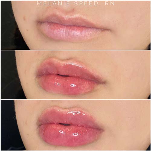 Lip Augmentation Before & After Photos by Flawless Medspa in Las Vegas NV