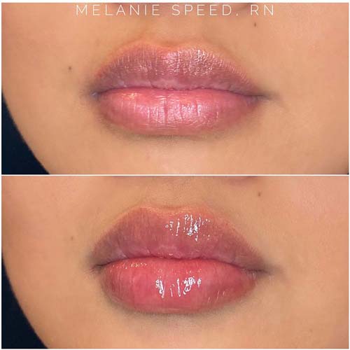 Lip Augmentation Before & After Photos by Flawless Medspa in Las Vegas NV