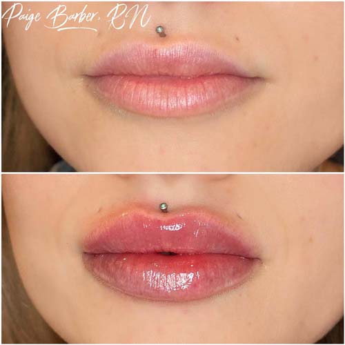 Lip Augmentation Before & After Photos by Flawless Medspa in Las Vegas NV