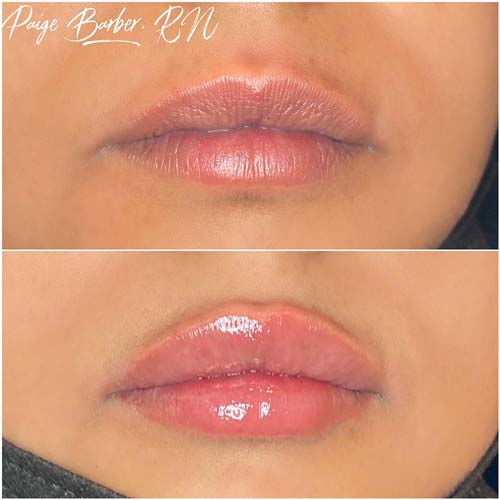 Lip Augmentation Before & After Photos by Flawless Medspa in Las Vegas NV