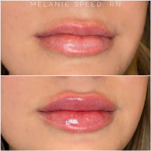 Lip Augmentation Before & After Photos by Flawless Medspa in Las Vegas NV