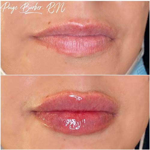 Lip Augmentation Before & After Photos by Flawless Medspa in Las Vegas NV