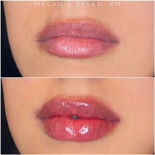 Lip Augmentation Before & After Photos by Flawless Medspa in Las Vegas NV