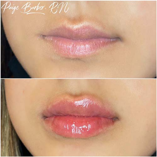 Lip Augmentation Before & After Photos by Flawless Medspa in Las Vegas NV