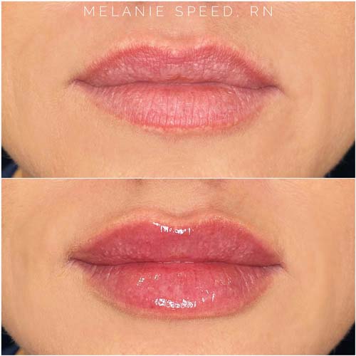 Lip Augmentation Before & After Photos by Flawless Medspa in Las Vegas NV