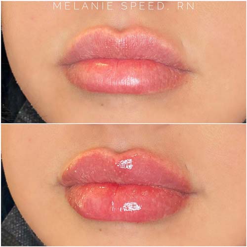 Lip Augmentation Before & After Photos by Flawless Medspa in Las Vegas NV